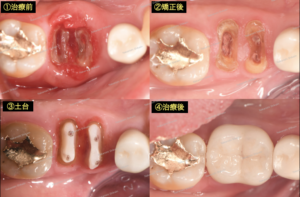 歯を抜かない・歯を残したい治療　矯正８